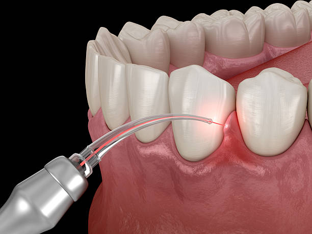 Gum treatment